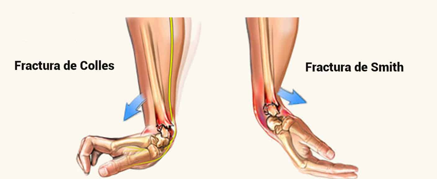 Fractura Distal De Radio ¿cuál Es Su Recuperación Clinica Handfix 9904