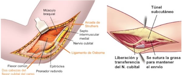 Transposición del nervio cubital